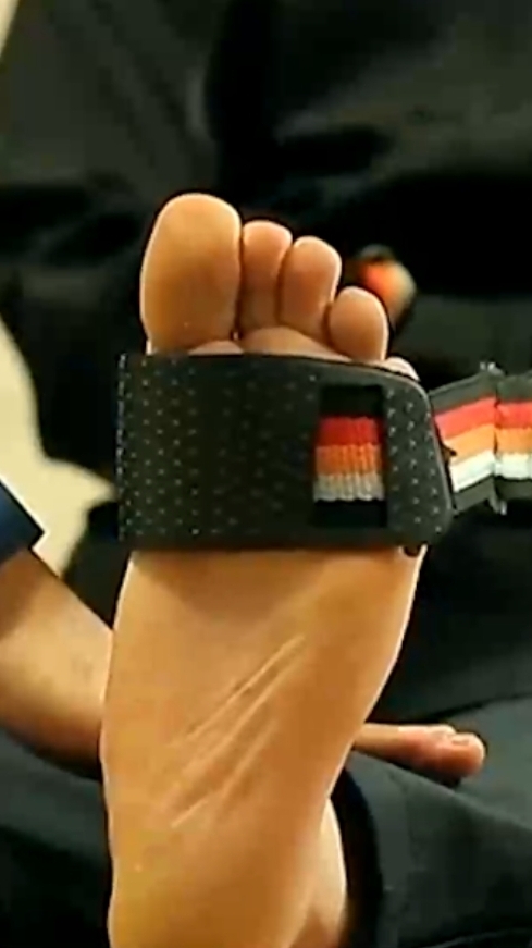 درمان خار پاشنه